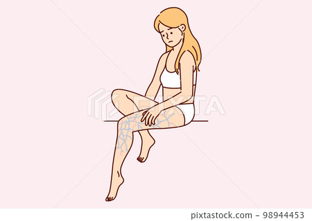 Upset woman in lingerie looks in bewilderment at leg with swollen veins after unsuccessful walk 98944453