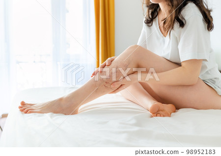Woman sitting on bed and shows her beautiful legs with varicosity. Concept of laser epilation and varicose Woman sitting on bed and shows her beautiful legs with varicosity. Concept of laser epilation and varicose 98952183