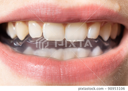 Dental mouthguard, splint in the mouth for the treatment of dysfunction of the temporomandibular joints, bruxism, malocclusion, to relax the muscles of the jaw. 98953106