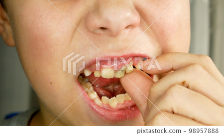 The child shakes the finger of the milk tooth. Close-up 98957888