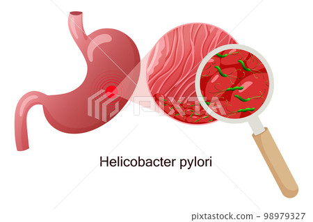Helicobacter pylori in stomach mucosa under magnifying glass. Helicobacter pylori in stomach mucosa under magnifying glass. 98979327