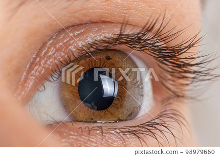 Macro eye photo. Keratoconus 2 degree - eye disease, thinning of the cornea in the form of a cone. The cornea plastic 98979660