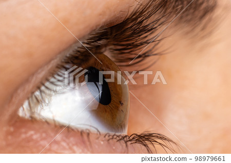 Macro eye photo. Keratoconus 2 degree - eye disease, thinning of the cornea in the form of a cone. The cornea plastic 98979661