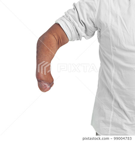 Disability, unique and arm amputee of a man with a injury showing forearm with mockup. Isolated, disabled model and white background of a male person pose with a different body and mock up space Disability, unique and arm amputee of a man with a injury showing forearm with mockup. Isolated, disabled model and white background of a male person pose with a different body and mock up space 99004783