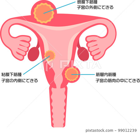 Types of uterine fibroids 99012239