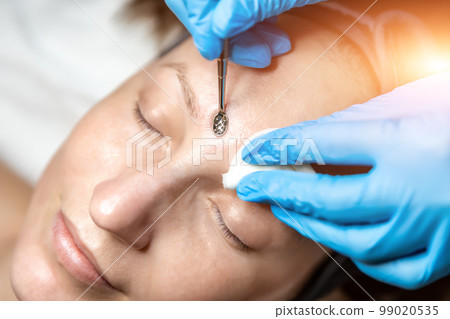 Close-up detail of beautician doctor hand in blue rubber protective gloves make blackhead spot pimples removal procedure for young adult female patient. Woman facial cleansing and skin care concept Close-up detail of beautician doctor hand in blue rubber protective gloves make blackhead spot pimples removal procedure for young adult female patient. Woman facial cleansing and skin care concept 99020535