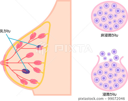 Illustrated illustration of breast cancer 99072046