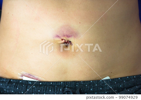 Woman's abdomen fresh medical scars after laparoscopy surgery, remove gallbladder, ovary, uterus, tumor. Wounds on woman's body, abdomen with band-aid. Belly button fresh stitches, hematoma, bruising. 99074929