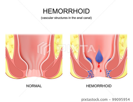 piles. comparison and difference between healthy colon and hemorrhoidal disease. 99095954