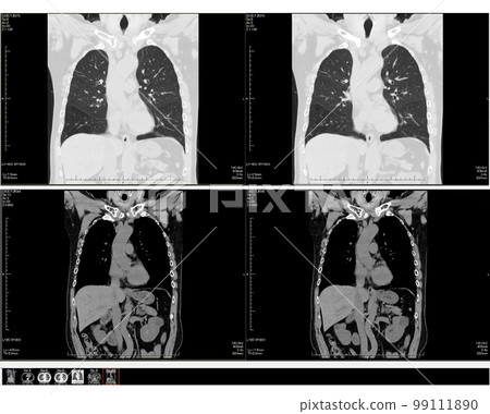 胸部 CT 掃描_01 99111890