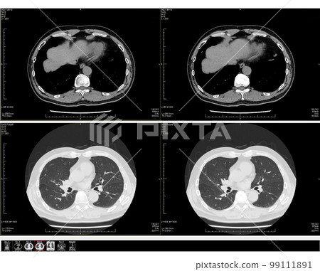 Chest CT scan_02 Chest CT scan_02 99111891