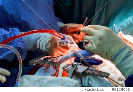 Due to malfunctioning heart valve, open heart surgery is required for during the procedure valve replacement in operating room 99129098