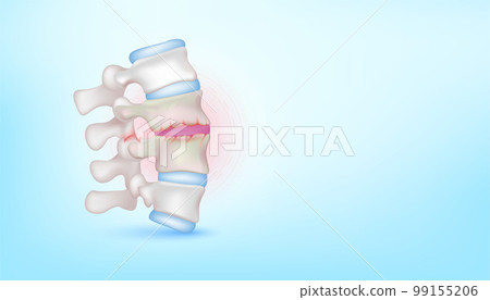 Backbone disc joint degeneration herniation cartilage on blue background with copy space for text. Bone human skeleton anatomy of the body. Medical health care science concept. Realistic 3D Vector. Backbone disc joint degeneration herniation cartilage on blue background with copy space for text. Bone human skeleton anatomy of the body. Medical health care science concept. Realistic 3D Vector. 99155206