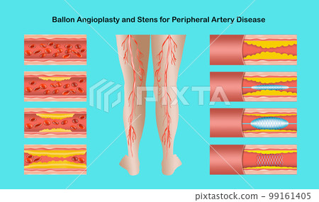 Diagram showing angioplasty for peripheral artery disease illustration 99161405