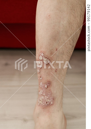 Acute psoriasis on the legs 99179142