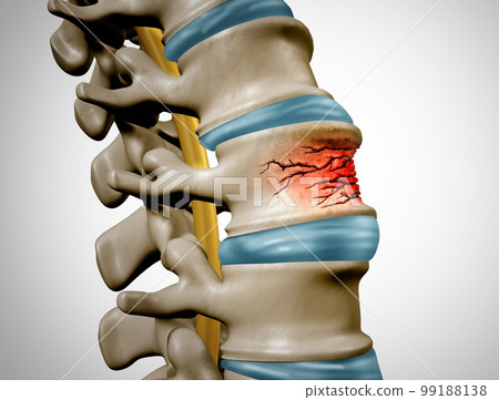 Traumatic Spine Fracture Traumatic Spine Fracture 99188138