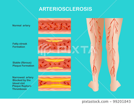 artery with blood cells desease 99201843