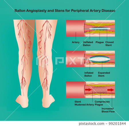 Diagram showing angioplasty for peripheral artery disease illustration Diagram showing angioplasty for peripheral artery disease illustration 99201844