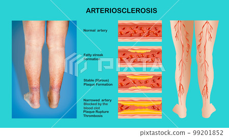 artery with blood cells desease artery with blood cells desease 99201852