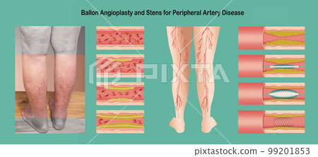 Diagram showing angioplasty for peripheral artery disease illustration Diagram showing angioplasty for peripheral artery disease illustration 99201853