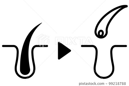 Pore cross section of hair removal, image illustration of hair removal clinic / hair removal salon 99218788