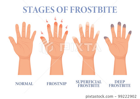 Frostbite stages. Frozen hands in different stages. Medical frostbite. Skin burn symptom. Health care medical concept. Vector Frostbite stages. Frozen hands in different stages. Medical frostbite. Skin burn symptom. Health care medical concept. Vector 99222902