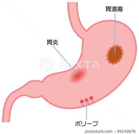 Illustration showing gastritis, stomach ulcer and polyp Illustration showing gastritis, stomach ulcer and polyp 99240676