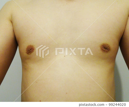 male inverted nipples 99244020