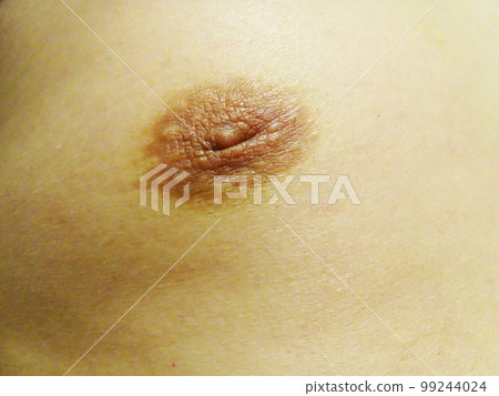男性乳頭內陷 99244024