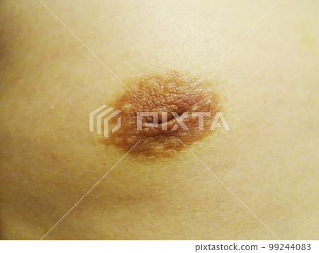 male inverted nipples 99244083