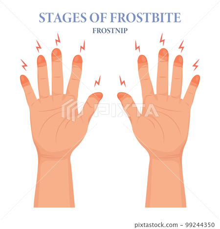 Frozen hands in different stages. Medical frostbite. Stages of frostbite of fingers. Skin burn symptom. Medical healthcare concept. Vector 99244350