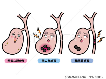 一套健康的膽囊、膽結石和膽總管結石 一套健康的膽囊、膽結石和膽總管結石 99248042