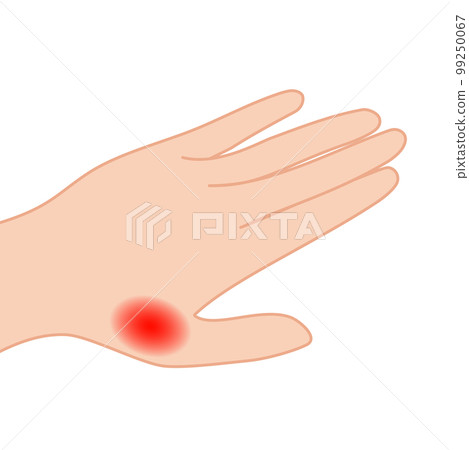 手拇指關節發炎的插圖 99250067