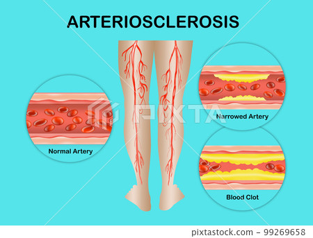 Human legs. Artery with blood cells desease. Concept of dry skin, old senior people Human legs. Artery with blood cells desease. Concept of dry skin, old senior people 99269658
