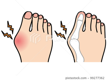 拇外翻足 拇外翻足 99277362