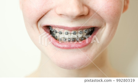 Close-up of a young woman smiling with braces on her teeth. 99280319