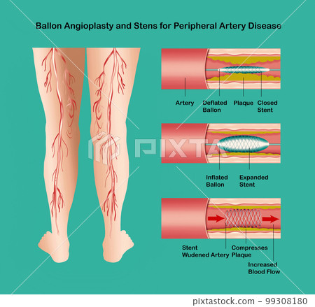 Diagram showing angioplasty for peripheral artery disease illustration Diagram showing angioplasty for peripheral artery disease illustration 99308180