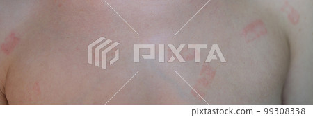 Red itchy patch rash on woman skin closeup Red itchy patch rash on woman skin closeup 99308338