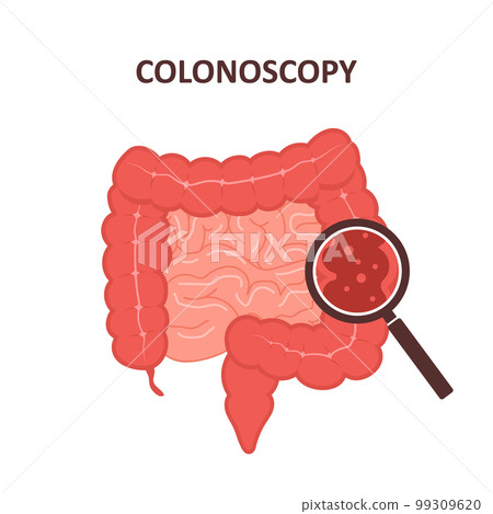 Colonoscopy concept. Intestine exam and treatment. Colon polypectomy procedure. Prevention of cancer. Vector illustration in flat cartoon style Colonoscopy concept. Intestine exam and treatment. Colon polypectomy procedure. Prevention of cancer. Vector illustration in flat cartoon style 99309620