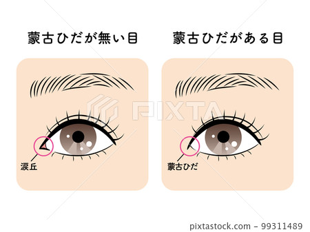 有和沒有蒙古褶皺的眼睛 99311489