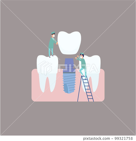 Two dentists perform dental implantation install the implant on the abutment. Vector illustration, in a flat style. Poster to the clinic, image for instructions for dentists, training books 99321758