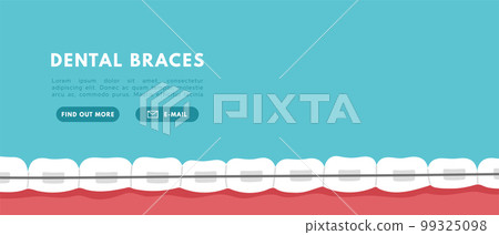 Teeth braces banner. Orthodontic problem, smile with brackets, retainer. Flat vector isolated illustration 99325098