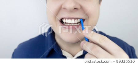Interdental brush. A man shows a brush for cleaning the interdental space. Brush for cleaning teeth and daily oral care. Dentistry and orthodontics  99326530