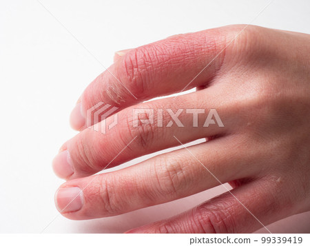 A woman's hand swollen with frostbite and chapped hands A woman's hand swollen with frostbite and chapped hands 99339419