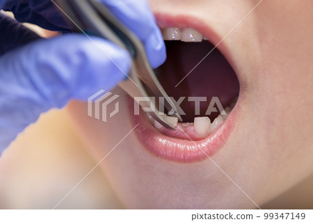 Children's teeth. The doctor extracts a child's tooth. Milk teeth in a child, close-up Children's teeth. The doctor extracts a child's tooth. Milk teeth in a child, close-up 99347149