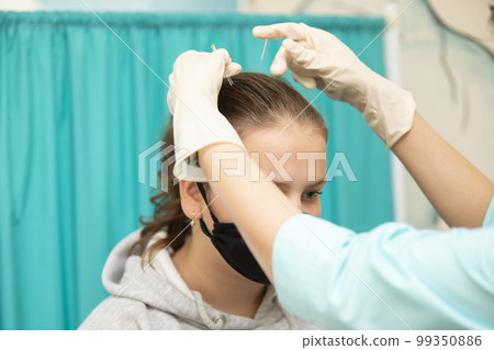 The doctor makes acupuncture on the head of a teen patient. 99350886
