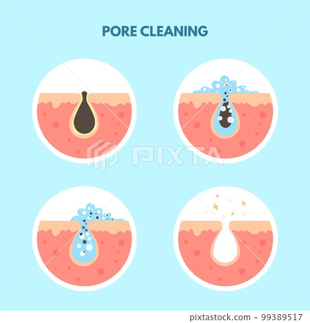 Removal skin blackheads. Acne oily skin cleansing process, used pimple foam remover or exfoliant, deep clean facial and body pore to spot blackhead sebum makeup vector illustration Removal skin blackheads. Acne oily skin cleansing process, used pimple foam remover or exfoliant, deep clean facial and body pore to spot blackhead sebum makeup vector illustration 99389517