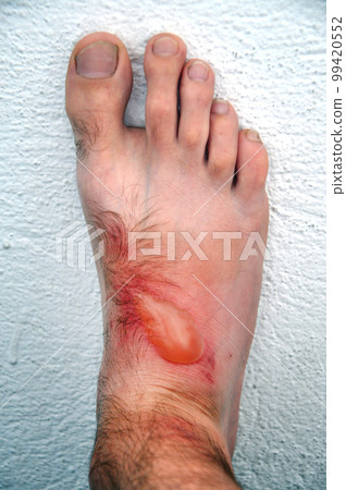 Phytophotodermatitis, cutaneous phototoxic skin inflammatory eruption from a plant named Dictamnus albus 99420552