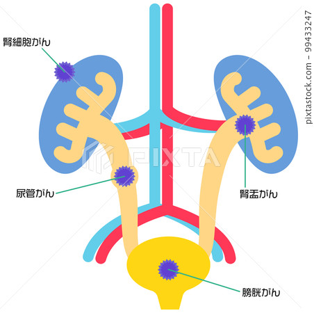 膀胱和腎臟周圍的癌症類型 99433247