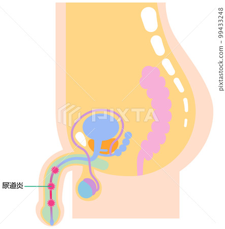 Illustration showing urethritis 99433248